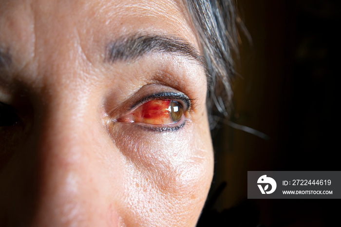 Close up of a severe bloodshot eye. Blepharitis, a condition of conjunctivitis in a woman after covid vaccine