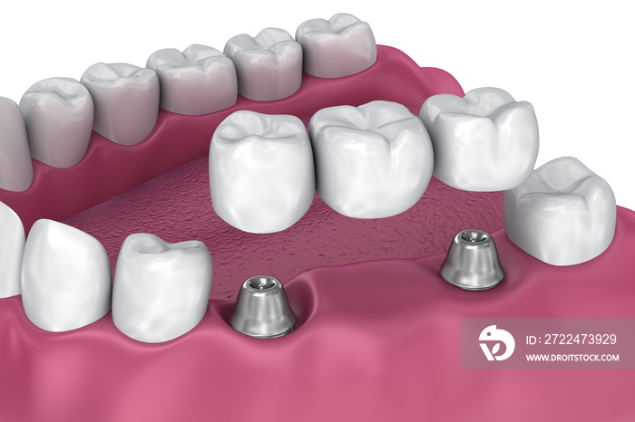 implant supported fixed bridge. Medically accurate 3D illustration