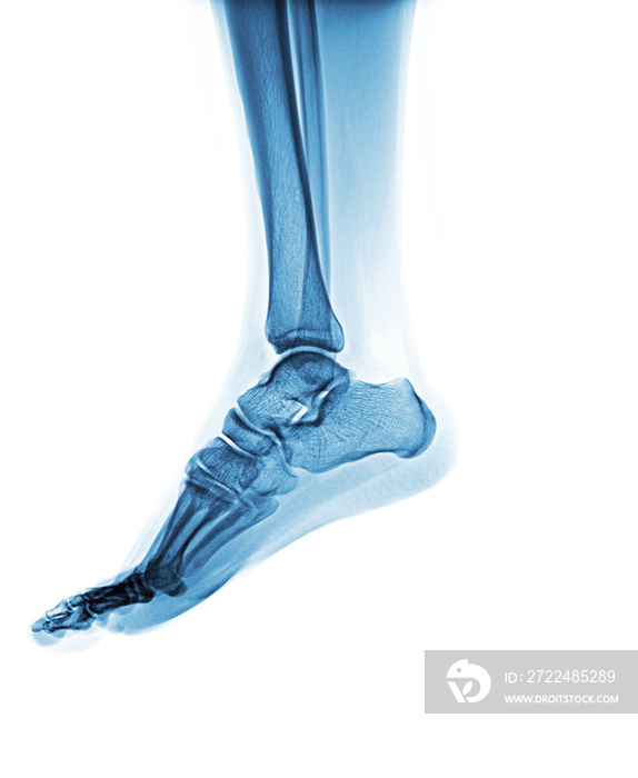 X-ray normal human foot . Lateral view