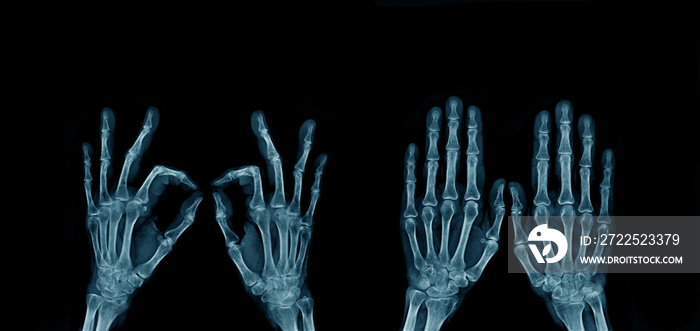手和手指的x射线图像