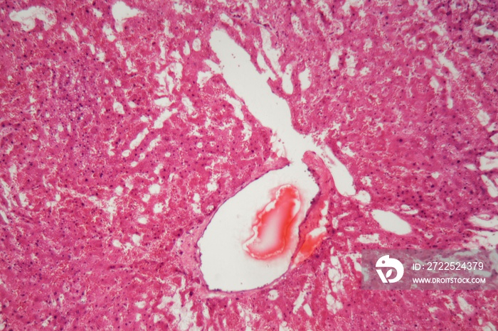 Liver tissue with Amyloidosis under a microscope.