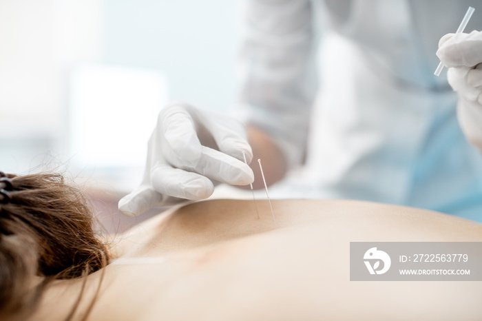 Close-up of the acupuncture medical treatment with special needles