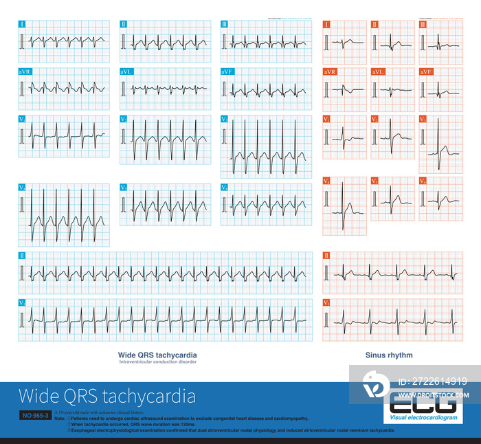 If there is basic intraventricular conduction disorder in sinus rhythm, wide QRS wave tachycardia can be seen in supraventricular tachycardia, which is easily misdiagnosed as ventricular tachycardia.