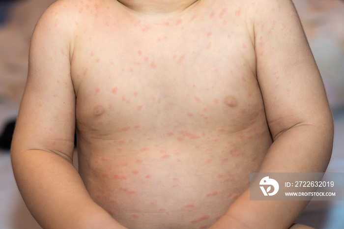 Chicken pox / varicella