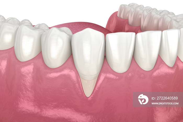 Gum Recession. 3D illustration of Dental problem