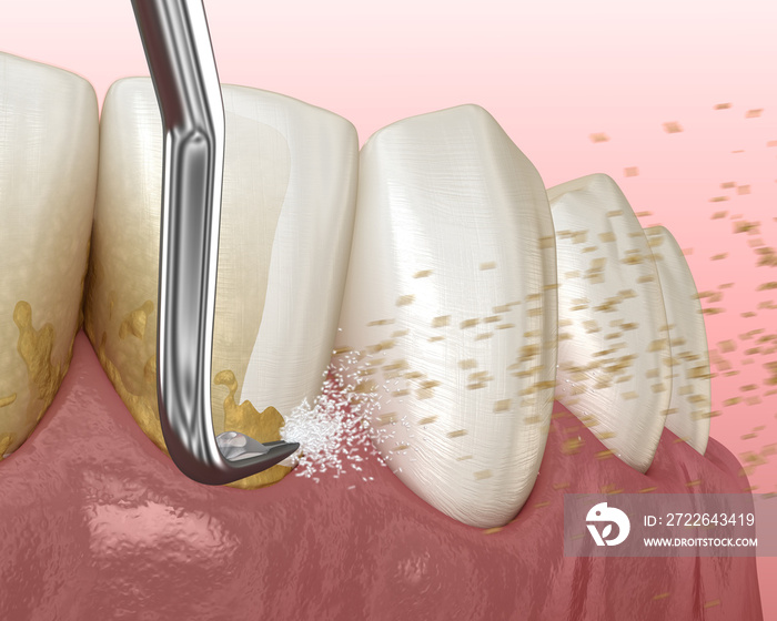 Oral hygiene: Scaling and root planing (conventional periodontal therapy). Medically accurate 3D illustration of human teeth treatment