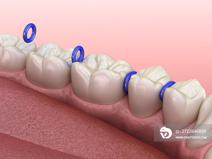 Rubber separator between teeth, preparation for braces placement. Medically accurate dental 3D illustration