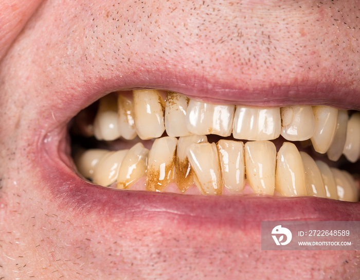 Close up of mouth with brown plaque stains