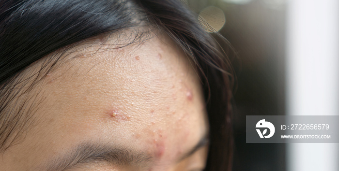 Acne pimple problem on forehead in Asian teenager woman skin face close up.