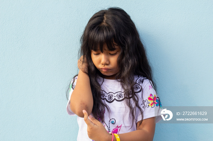 Asian little girl pointed her finger at her elbow because Dark patches on the skin and allergic rash known as acanthosis nigricans look like a darkened velvet.