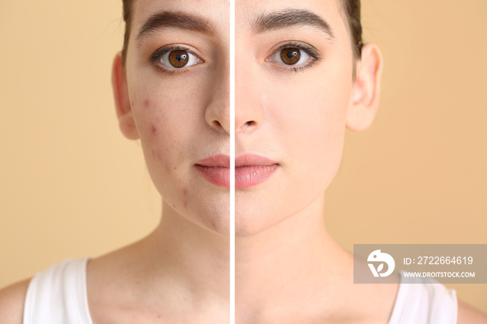 Young woman before and after acne treatment on color background