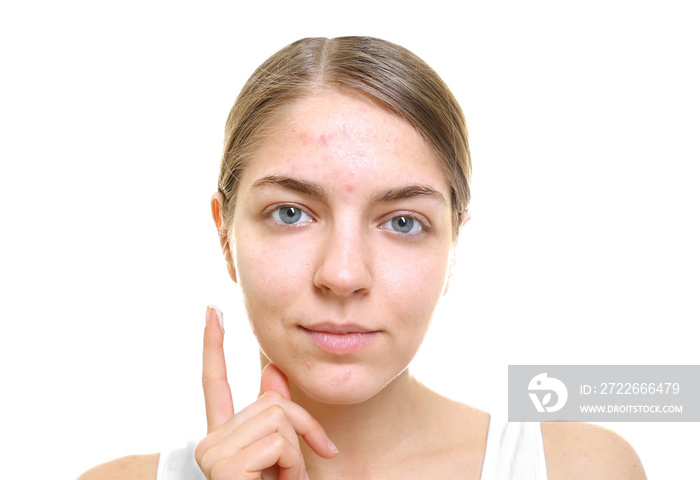 Beautiful young woman applying cream for problem skin onto face, on white background