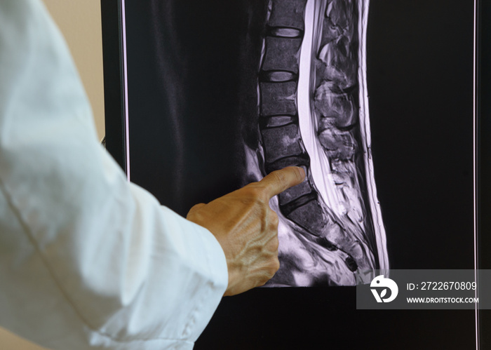 Doctor pointing at lumbar spine MRI