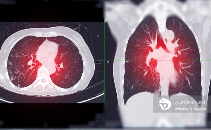 CT Chest or CT Scan of Lung Axial  and sagittal View.