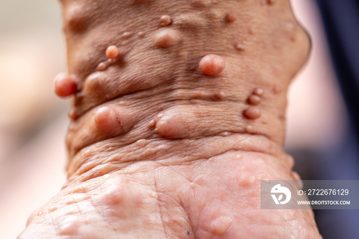 Background of human skin with Neurofibromatosis are a group of genetic disorders that cause tumors to form on nerve tissue, These tumors can develop anywhere in the nervous system.