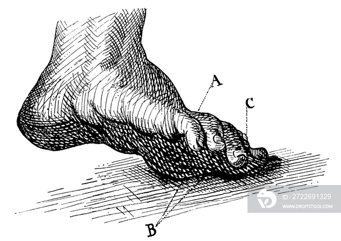 Corns (A, C) and pithy calluses (B). Illustration of the 19th century. Germany. White background.