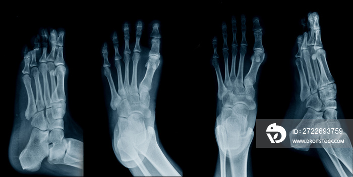 collection foot x-ray