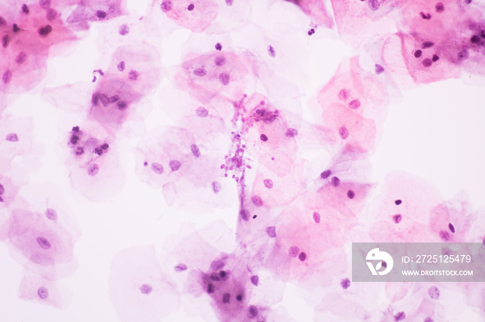 View in microscopic of Candidiasis, fungus infection (Yeast and Pseudohyphae form) in pap smear slid