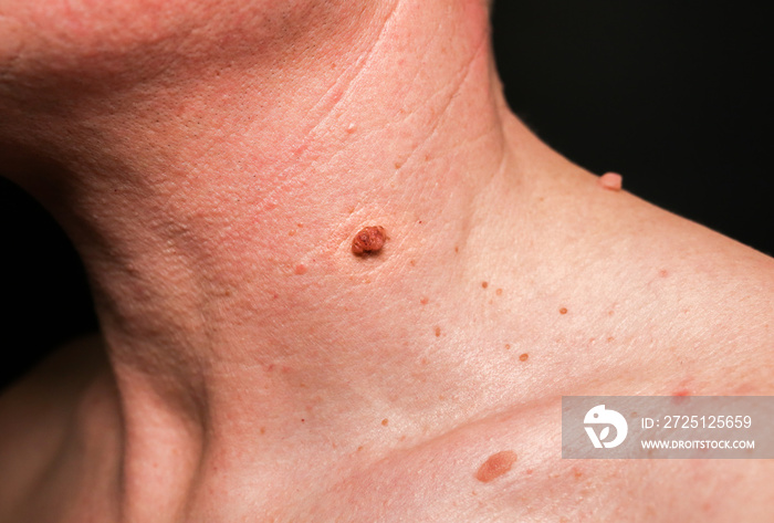 Big birthmark on the mans skin. Medical health photo. Papillomas on the neck.