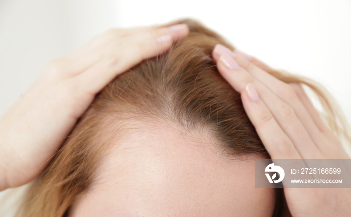 Young woman with hair loss problem on light background, closeup