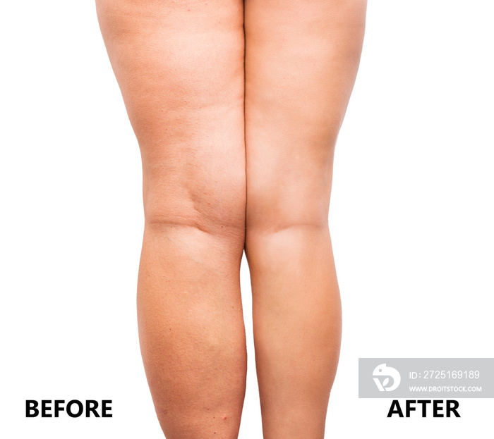 Womans legs before and after weight loss