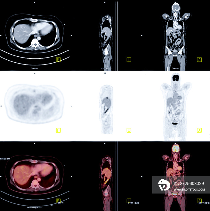 全身PET扫描图像对比轴向、冠状面和矢状面发现癌症疾病