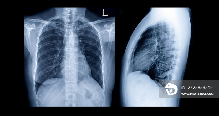 Comparison of Chest X-ray PA and Lateral view or X-Ray Image Of Human Chest  for screening heart dis