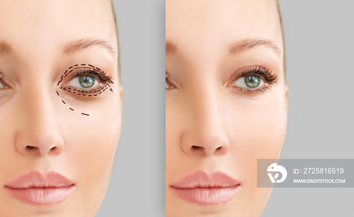 Lower and upper  Blepharoplasty.Marking the face.Perforation lines on females face, plastic surgery 