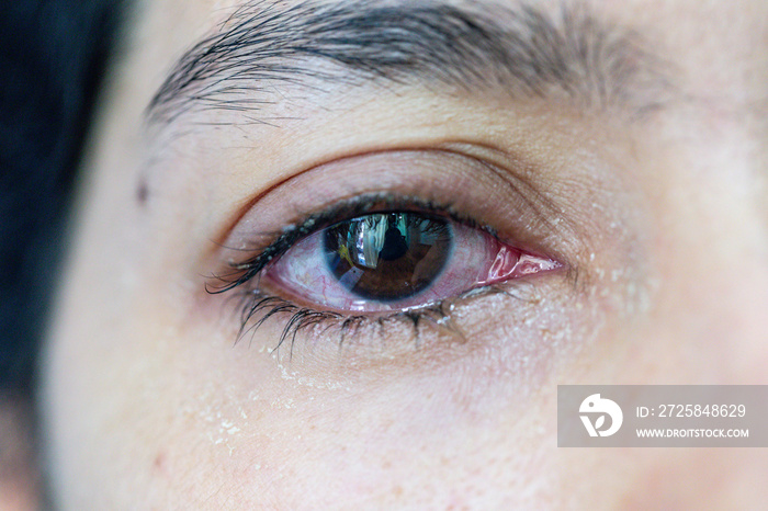 Closeup  of irritated red eye of a patient with human conjunctivitis or infected red bloodshot eye