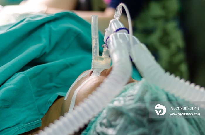 Patient with an endotracheal tube in operation theater