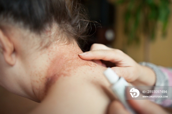 A nurse lubricating damaged eczema neck by healing ointment (color toned image)