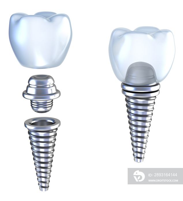 牙科种植体三维冠与针隔离在白色
