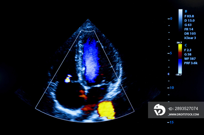 人类心脏超声监视器的彩色图像