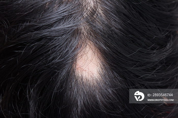 斑秃-斑点性脱发是一种头发从b的某些或所有区域脱落的情况