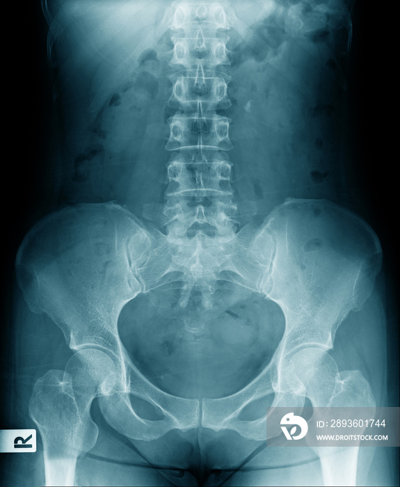 x-ray lower back with pelvic bone show lumbar spondylosis