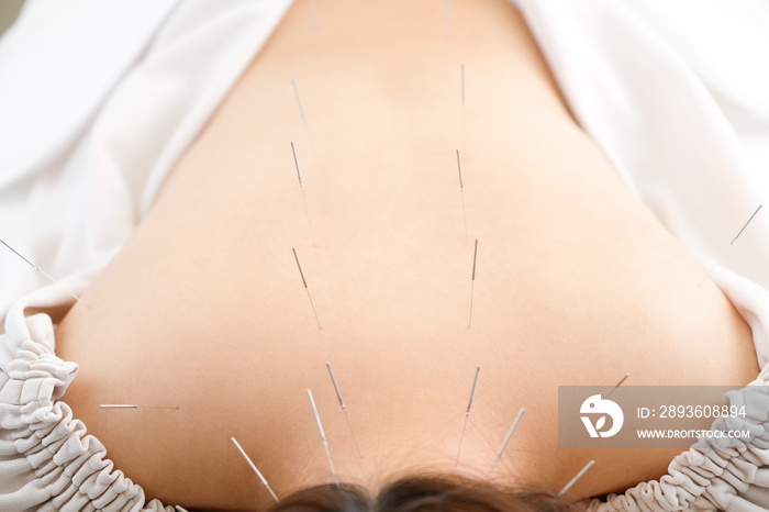 明るい鍼灸院で針を背中に刺される女性
