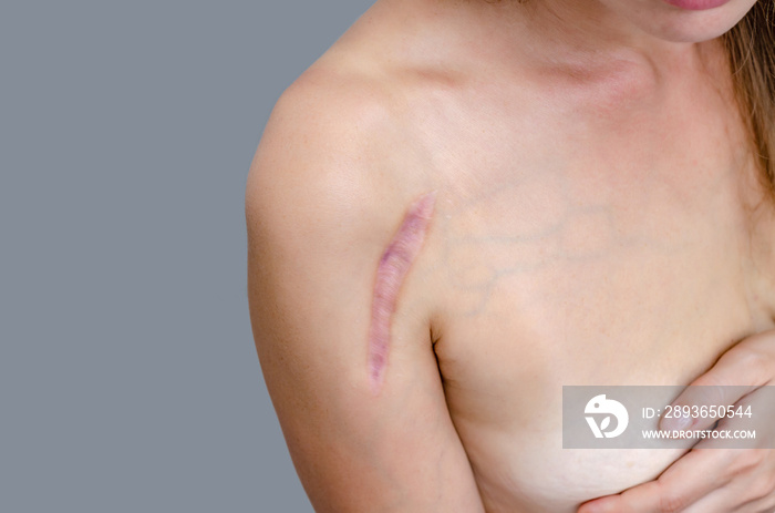 手术安装金属板骨折后有疤痕的女性肩部特写。Healin