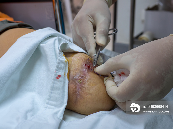 Doctor suturing for repair the amputation wound in patient who have diabetic disease.