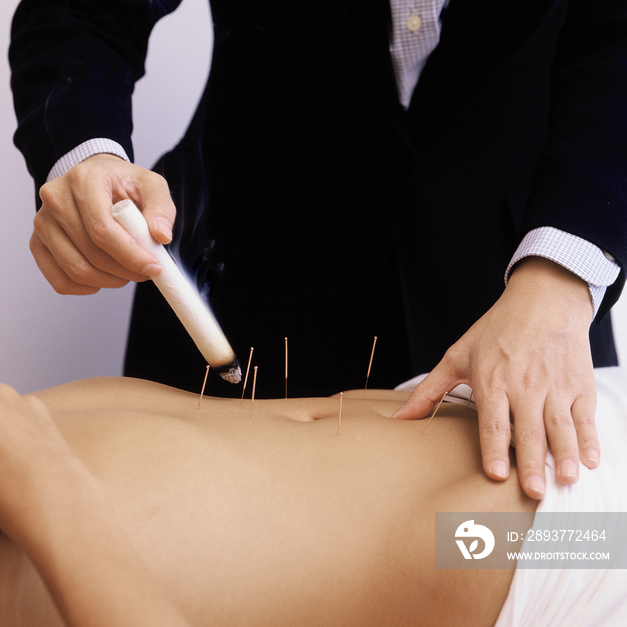 Woman having moxibustion treatment and acupuncture