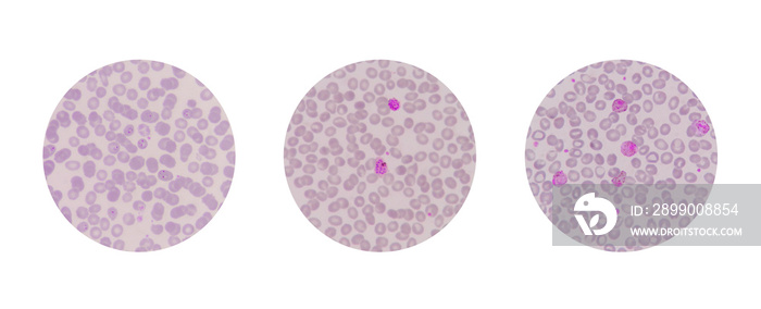 Microscopic examination of blood films from malaria infected pat