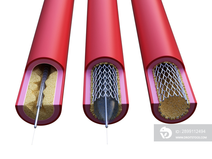 支架放置的三维医学精确图示