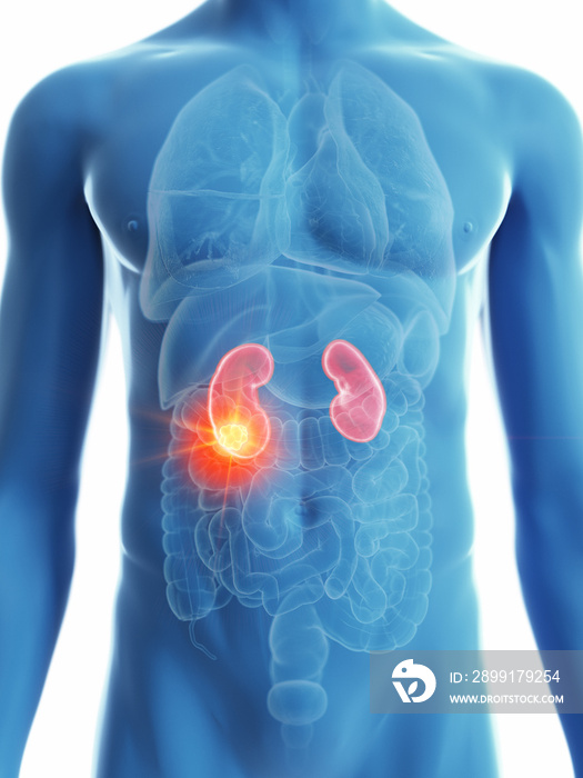 3d rendered medically accurate illustration of a mans kidney cancer