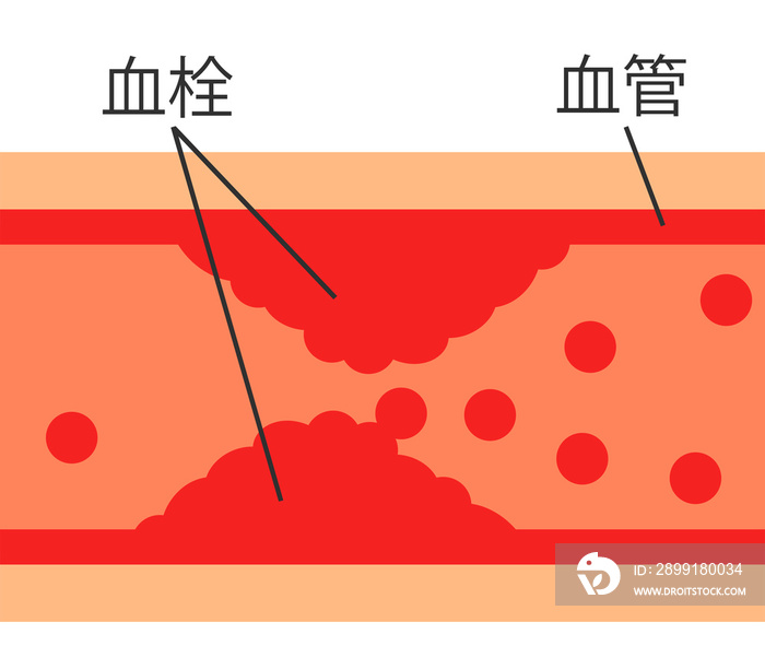 血管内の血栓