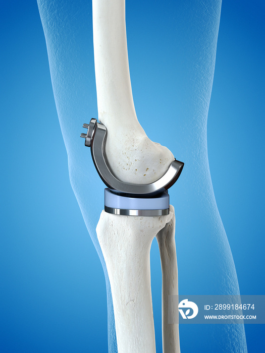 膝关节置换术的三维医学精确图示