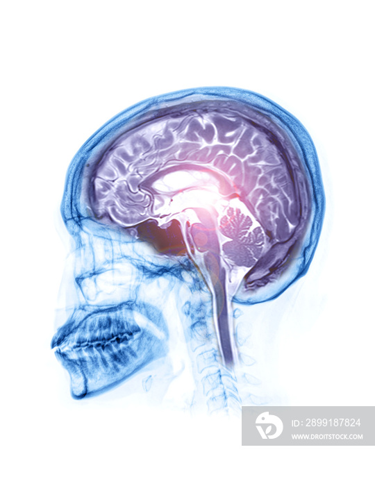 医学背景概念的颅骨x射线侧视图与MRI脑矢状面视图的融合。