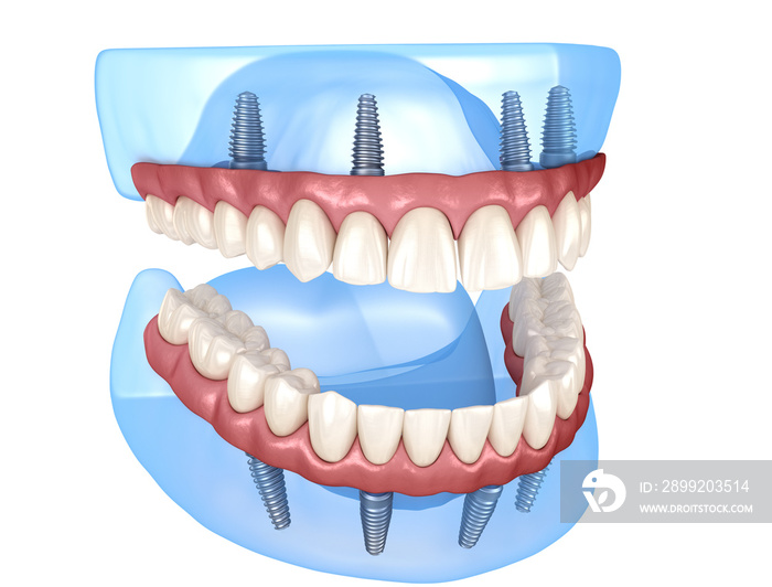 Maxillary and Mandibular prosthesis with gum All on 4 system supported by implants. Medically accurate 3D illustration of human teeth and dentures