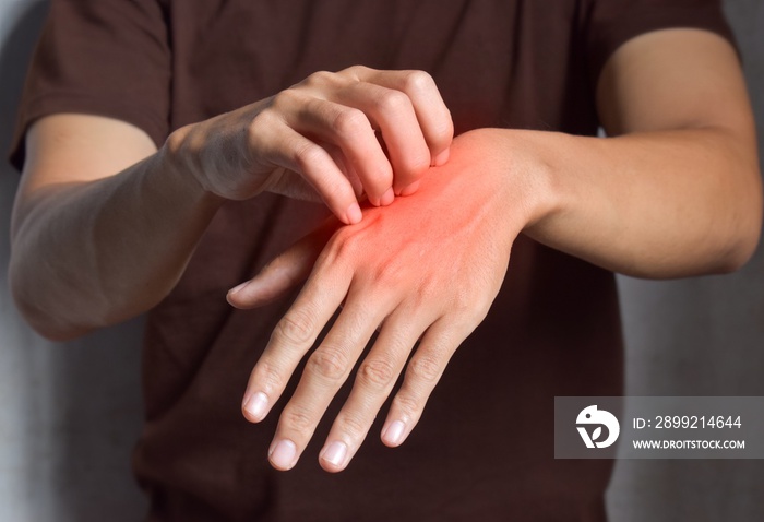 Asian man scratching his hand. Concept of itchy skin diseases such as scabies, fungal infection, eczema, psoriasis, rash, allergy, etc.