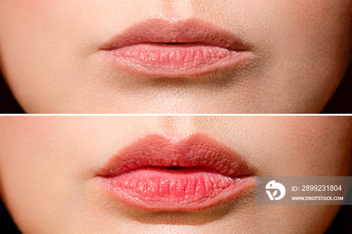 Result before and after lip shaping. A woman makes lip shape correction in a cosmetology clinic. Lip injections, lip augmentation.