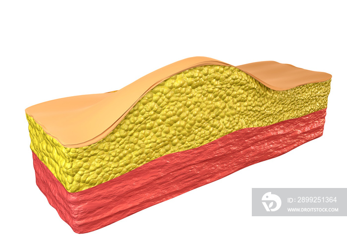 Lipoma - a benign tumor composed of adipose tissue cells (adipocytes), which accumulate inside a fibrous capsule just below the skin in the subcutaneous tissue