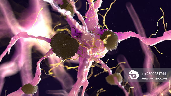 3d rendered medically accurate illustration of amyloid plaques on a nerve cell - alzheimer disease